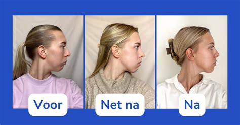 Voor-en-na foto's van ontharingsbehandelingen