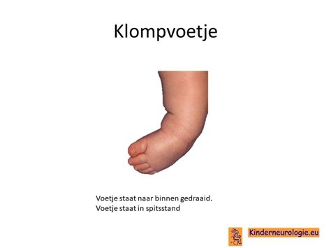 illustratie van een klompvoetje