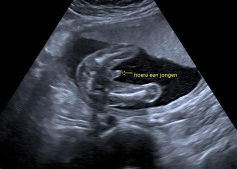 Gedetailleerde echofoto van een vroege zwangerschap