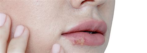 Collage van afbeeldingen die verschillende toepassingen van zinkzalf illustreren: babybilletjes, een koortslip, een insectenbeet.