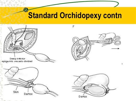 Illustratie van een inguinale orchidopexie procedure.