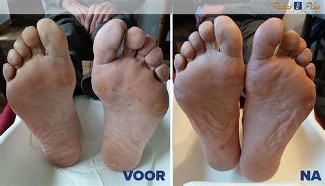 Close-up van verzorgde voeten na een pedicurebehandeling.