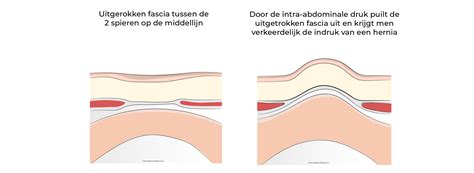 Een illustratie die de anatomie van een navelbreuk toont, met de uitstulping van het buikvlies door een zwakke plek in de buikwand.
