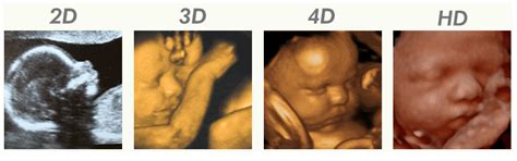 Voorbeeld van een 3D/4D echo van een baby