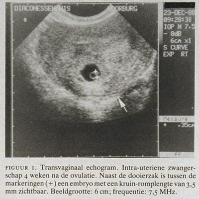 Echo van een vroege zwangerschap waarin de vruchtzak zichtbaar is.