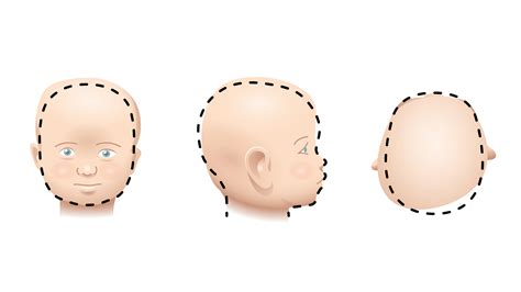 Schematische weergave van de plaatsing van een vacuümcup op het hoofd van de baby tijdens een kunstverlossing.