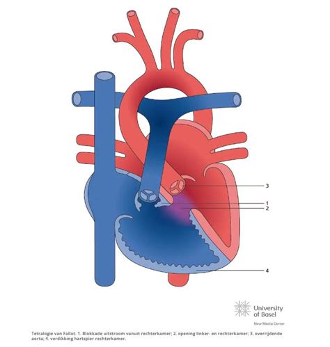 Illustratie die de bloedstroom in een ventrikelseptumdefect (VSD) met links-rechtsshunt en pulmonale hypertensie weergeeft.