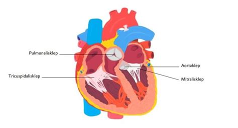 Diagram van een normale pulmonalisklep versus een vernauwde pulmonalisklep bij pulmonaalstenose.