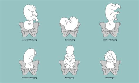 Illustratie van de verschillende mogelijke liggingen van een baby in de baarmoeder: achterhoofdligging, stuitligging, voorhoofdsligging, aangezichtsligging en dwarsligging.
