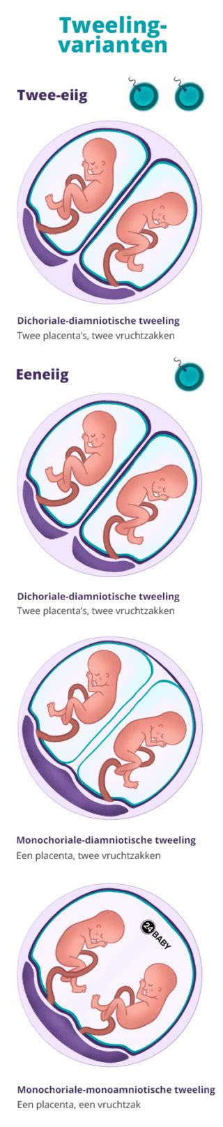 Verschillende soorten tweelingzwangerschappen met hun placenta- en vruchtzakstructuur