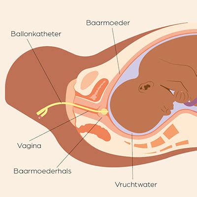 Schema van een ballonkatheter die in de baarmoederhals is ingebracht.