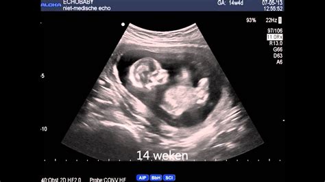 een echo-afbeelding van een foetus rond de 20 weken