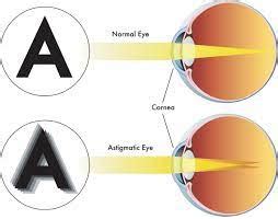 Illustratie van astigmatisme: lichtstralen convergeren op verschillende punten