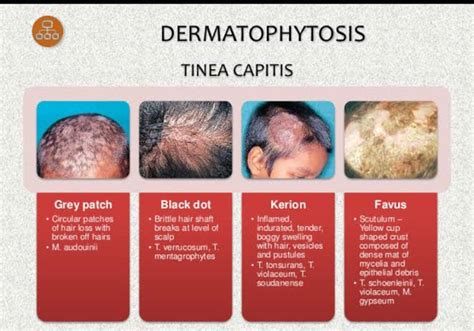 illustratie die verschillende typen tinea capitis toont: schilfering, kale plekken, kerion en favus