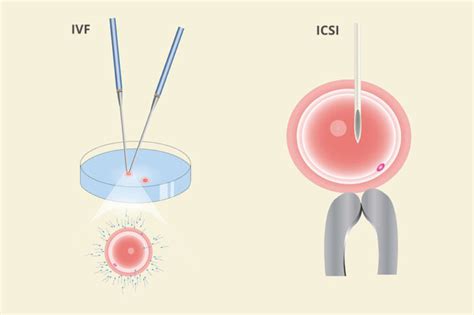 schema van IVF- en ICSI-behandelingen