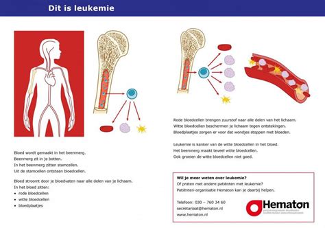 Infographic die de verschillende typen leukemie (AML, ALL, CML) en hun kenmerken visualiseert.
