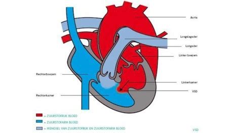 illustratie van een ventrikelseptumdefect (VSD)