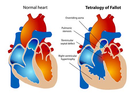 diagram van de tetralogie van Fallot, met de vier kernafwijkingen
