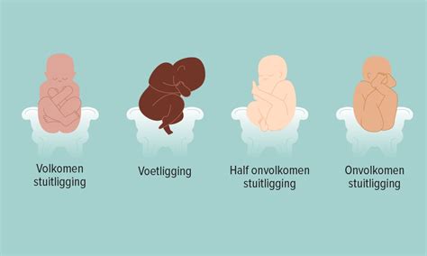 Illustratie van verschillende vormen van stuitligging: onvolkomen, volkomen en voetligging.