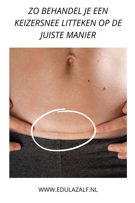 Illustratie van een litteken op de baarmoeder na een keizersnede.