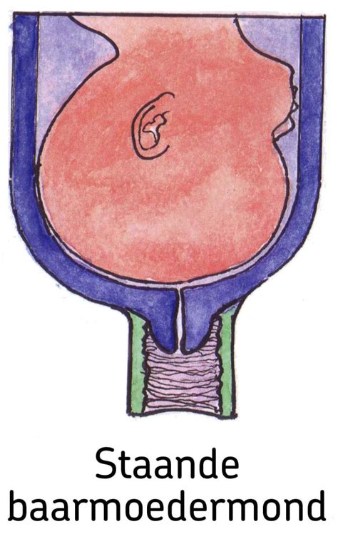 Illustratie van een baarmoedermond die wordt gestript door een verloskundige