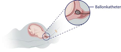 Illustratie van een ballonkatheter die wordt ingebracht in de baarmoedermond
