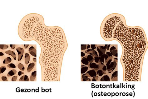 illustratie van een gezonde botstructuur versus een botstructuur aangetast door rachitis