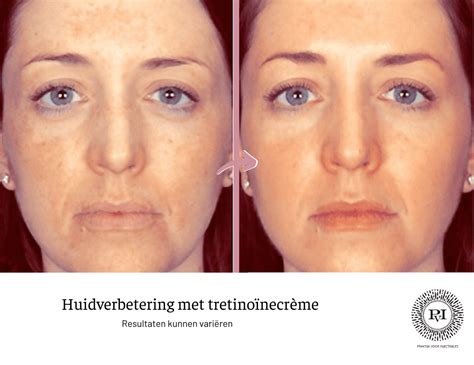 Schema met de stappen voor het correct aanbrengen van tretinoïne crème.