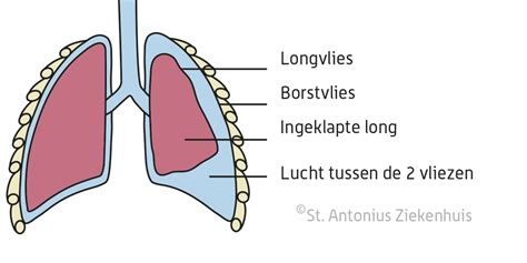 Schema dat het ontstaan van een klaplong illustreert