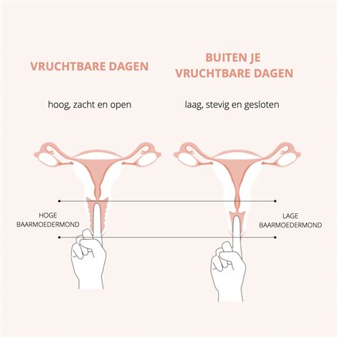 illustratie van een baarmoedermond met een poliep