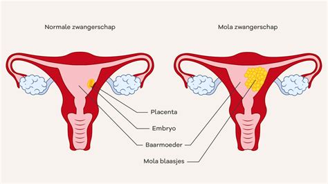 Illustratie van een echo-opname die de blaasjesstructuur van een mola-zwangerschap toont