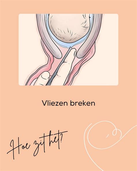 Schematische weergave van de vliezen rondom de foetus