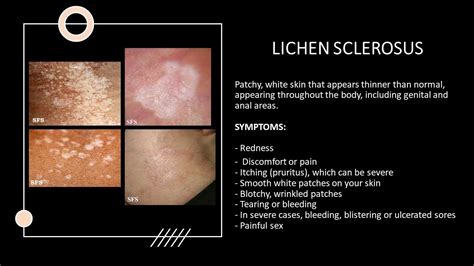 Illustratie van de vulva die de affected areas bij lichen sclerosus toont.