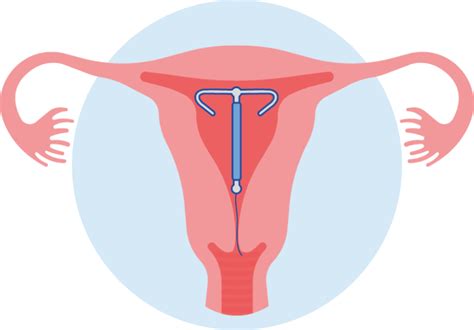 diagram van een koperspiraal in de baarmoeder