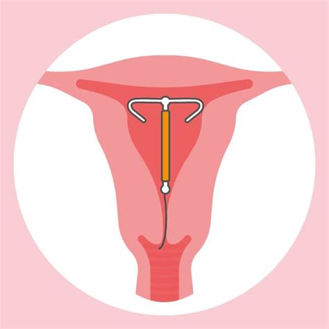 Illustratie van een T-vormig koperspiraaltje met draadjes