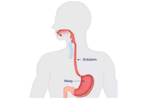Illustratie van het spijsverteringskanaal met focus op de maag en slokdarm, die de terugstroom van maagzuur toont.