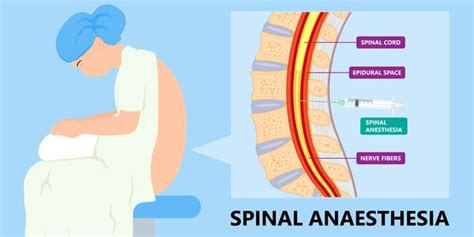 Visuele weergave van de werking van spinale anesthesie met intrathecale morfine