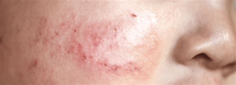 Illustratie van een baby met eczeem op de wangen