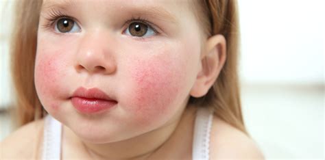 Illustratie van de kenmerkende rode wangen bij de vijfde ziekte