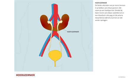 Illustratie van de verschillende typen aangeboren nierafwijkingen, zoals hoefijzernier, mega-ureter en UPJ-stenose.