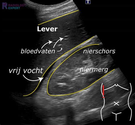 Echografische weergave van een ovariumcyste bij een foetus