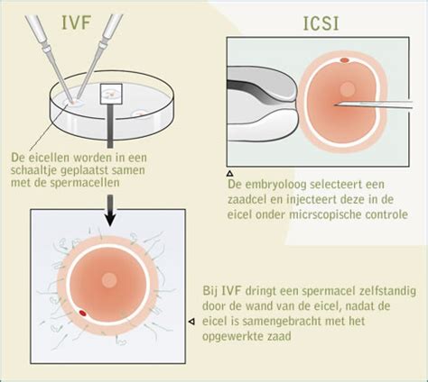 Infographic die de stappen van een IVF/ICSI-behandeling toont, van stimulatie tot terugplaatsing en zwangerschapstest.