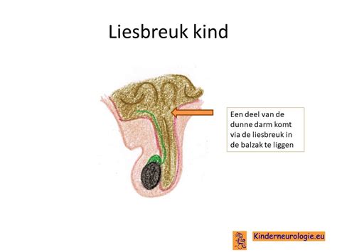 Illustratie van een beklemde liesbreuk met vastzittende darm.