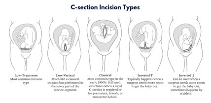 Illustratie van de incisie bij een bikinisnede tijdens een keizersnede.