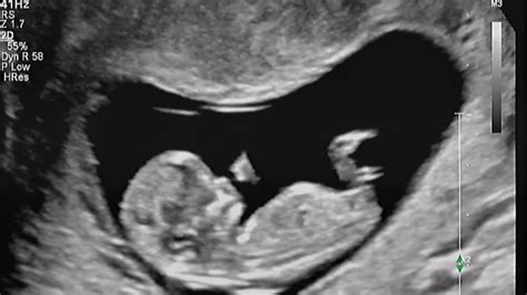 Voorbeeld van een 8K echo foto van een baby