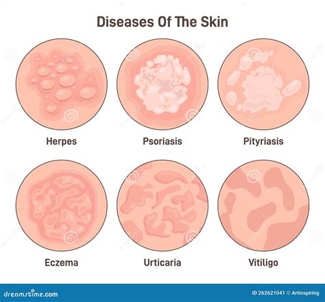 Diagram dat de verschillende soorten progesterontoediening (vaginaal, intramusculair) en hun potentiële effecten op vroeggeboorte bij meerlingzwangerschappen illustreert.