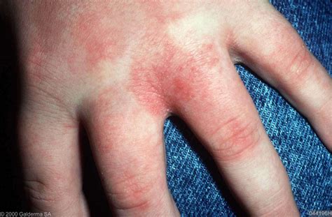 Foto van handen met zichtbare jeuk of huidirritatie op de handpalmen.