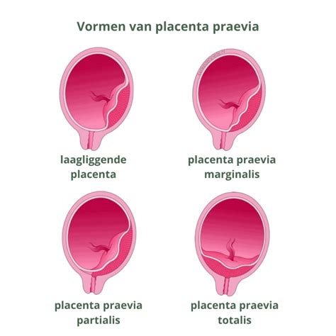 Diagram dat de verschillende vormen van placenta praevia illustreert: totalis, partialis, marginalis en laagliggend.