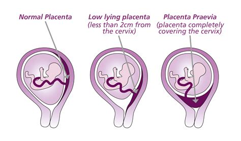 Schematische weergave van een placenta praevia, waarbij de placenta de baarmoedermond bedekt.