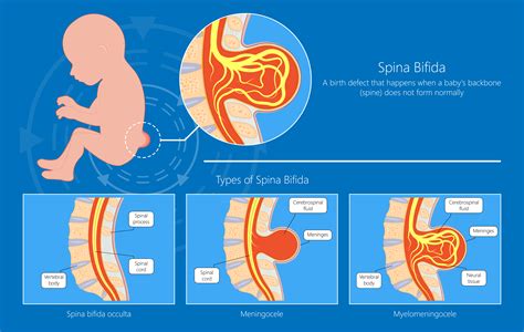 Illustratie van spina bifida occulta, waarbij de wervelbogen niet gesloten zijn, maar de structuren bedekt zijn met huid.